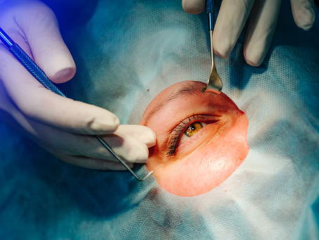 Cataract